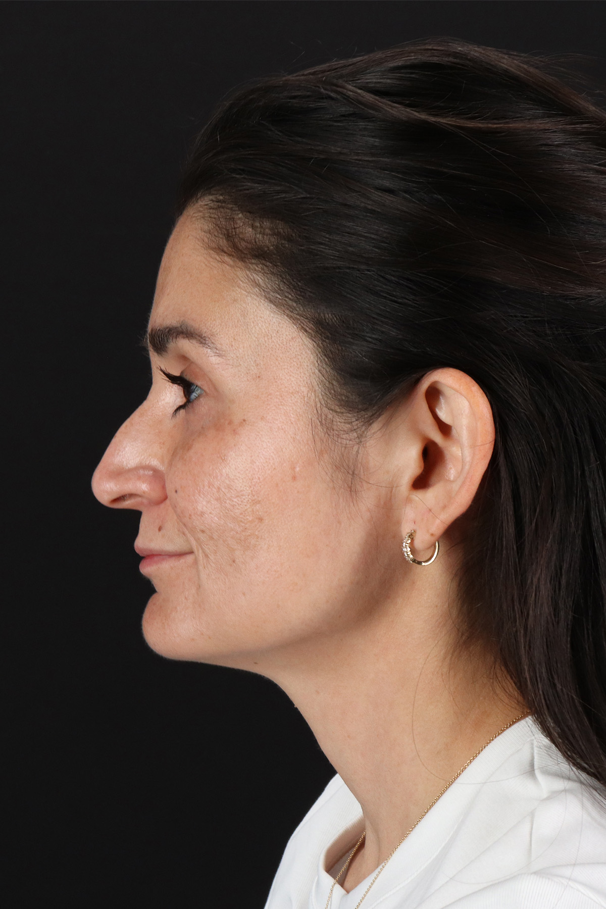 CO2 Laser Before & After Patient #10936