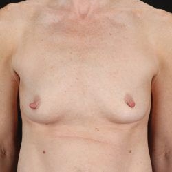 Breast Augmentation with Implants Before & After Patient #10958