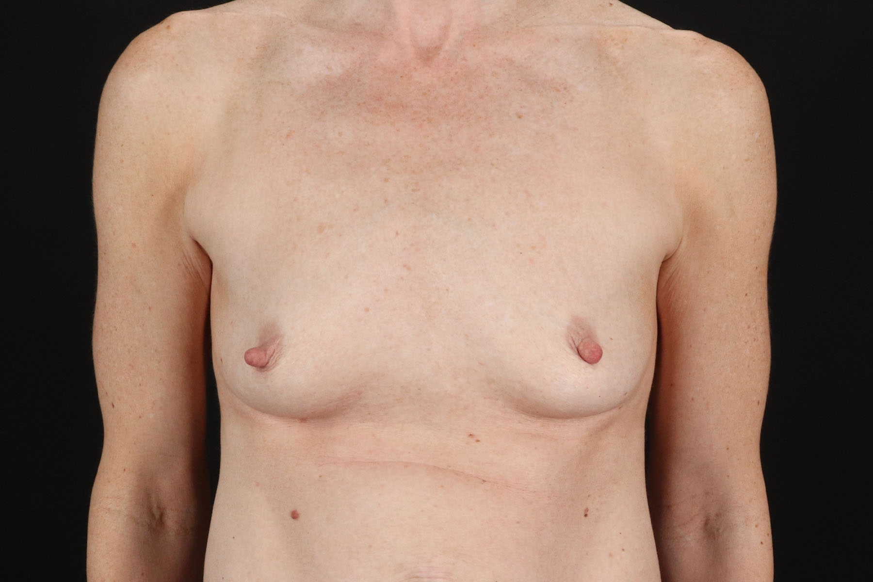 Breast Augmentation with Implants Before & After Patient #10958