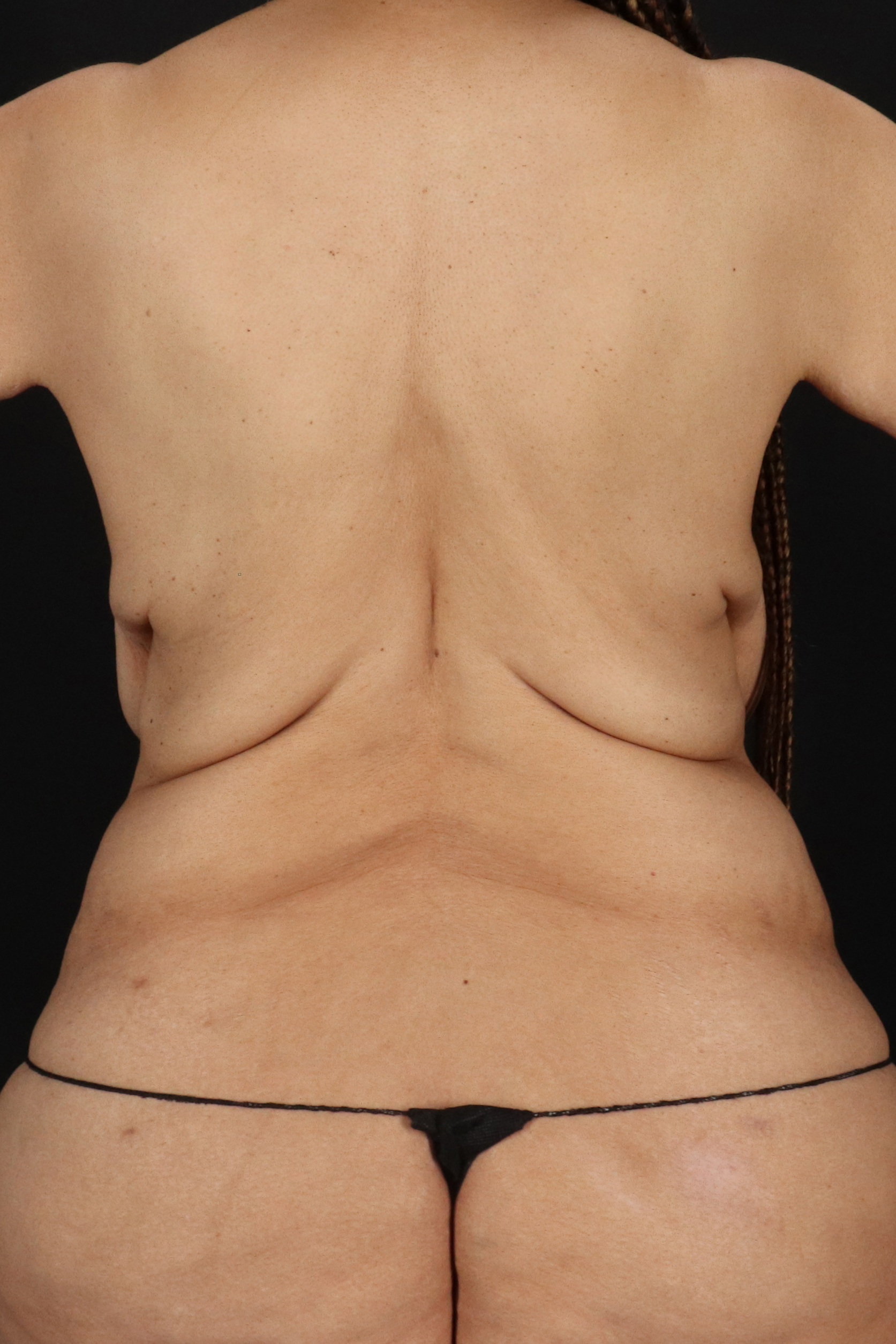 All Me Augmentation Before & After Patient #10285
