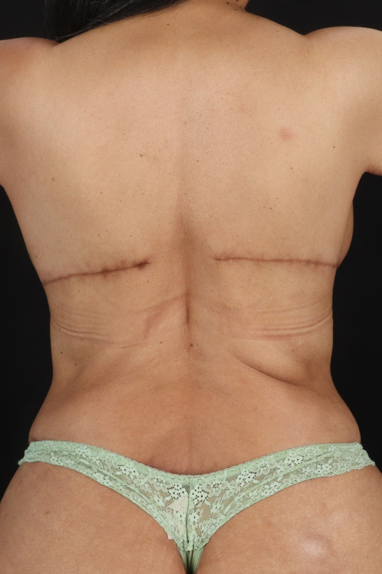 All Me Augmentation Before & After Patient #10285