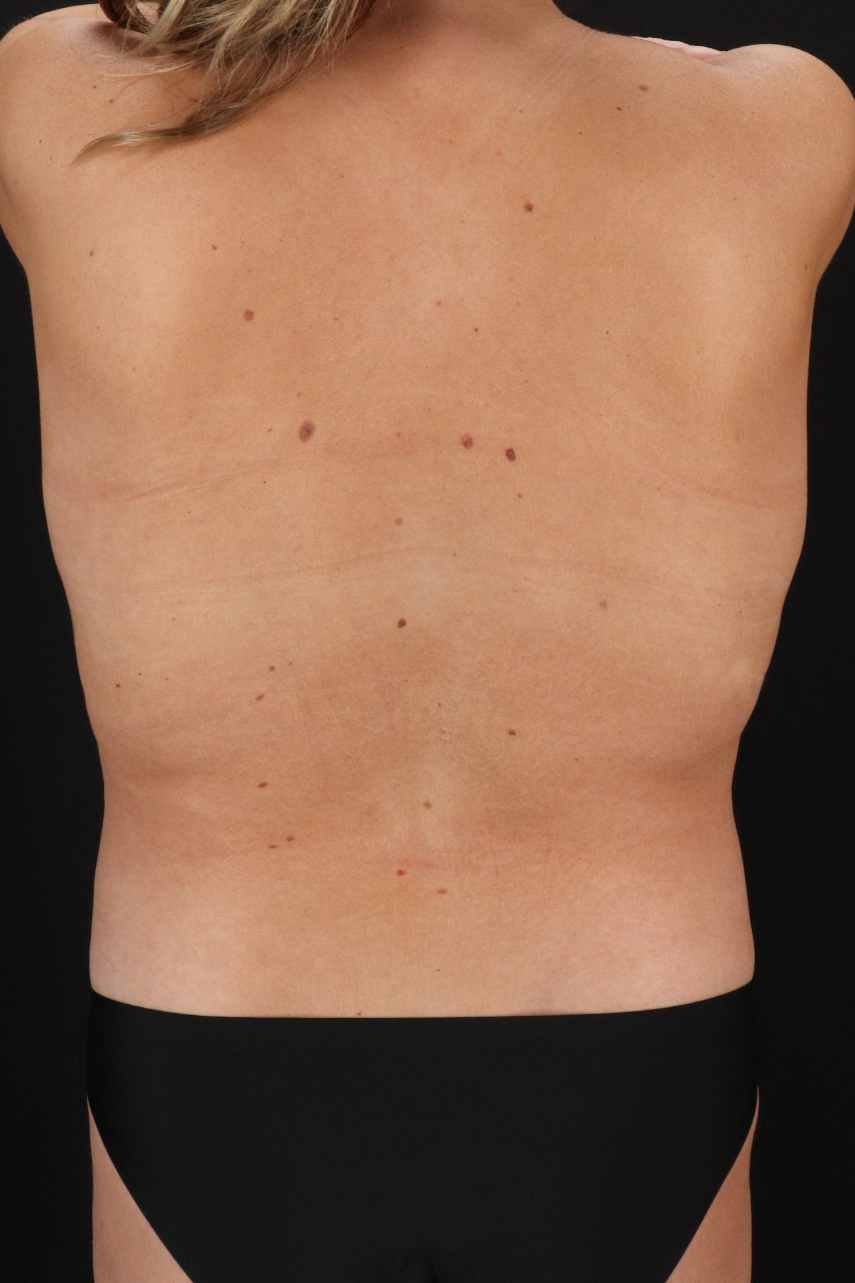 All Me Augmentation Before & After Patient #10287