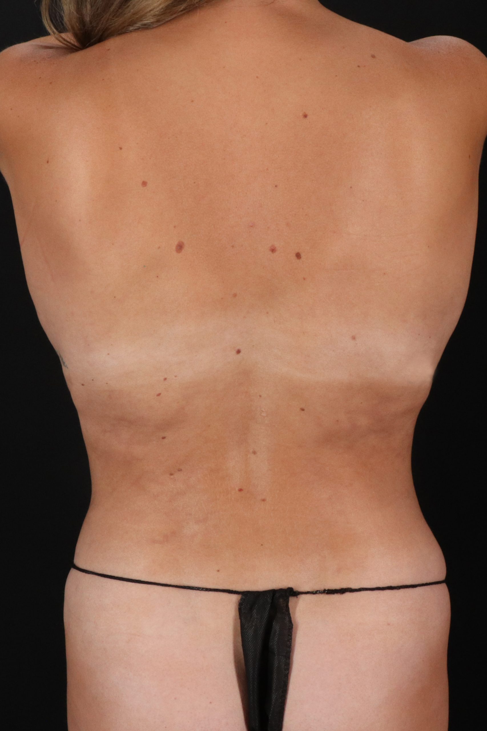 All Me Augmentation Before & After Patient #10287
