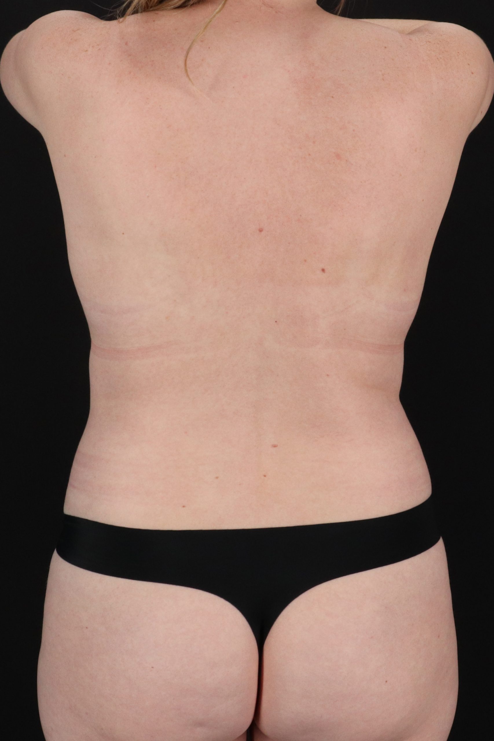 All Me Augmentation Before & After Patient #10288