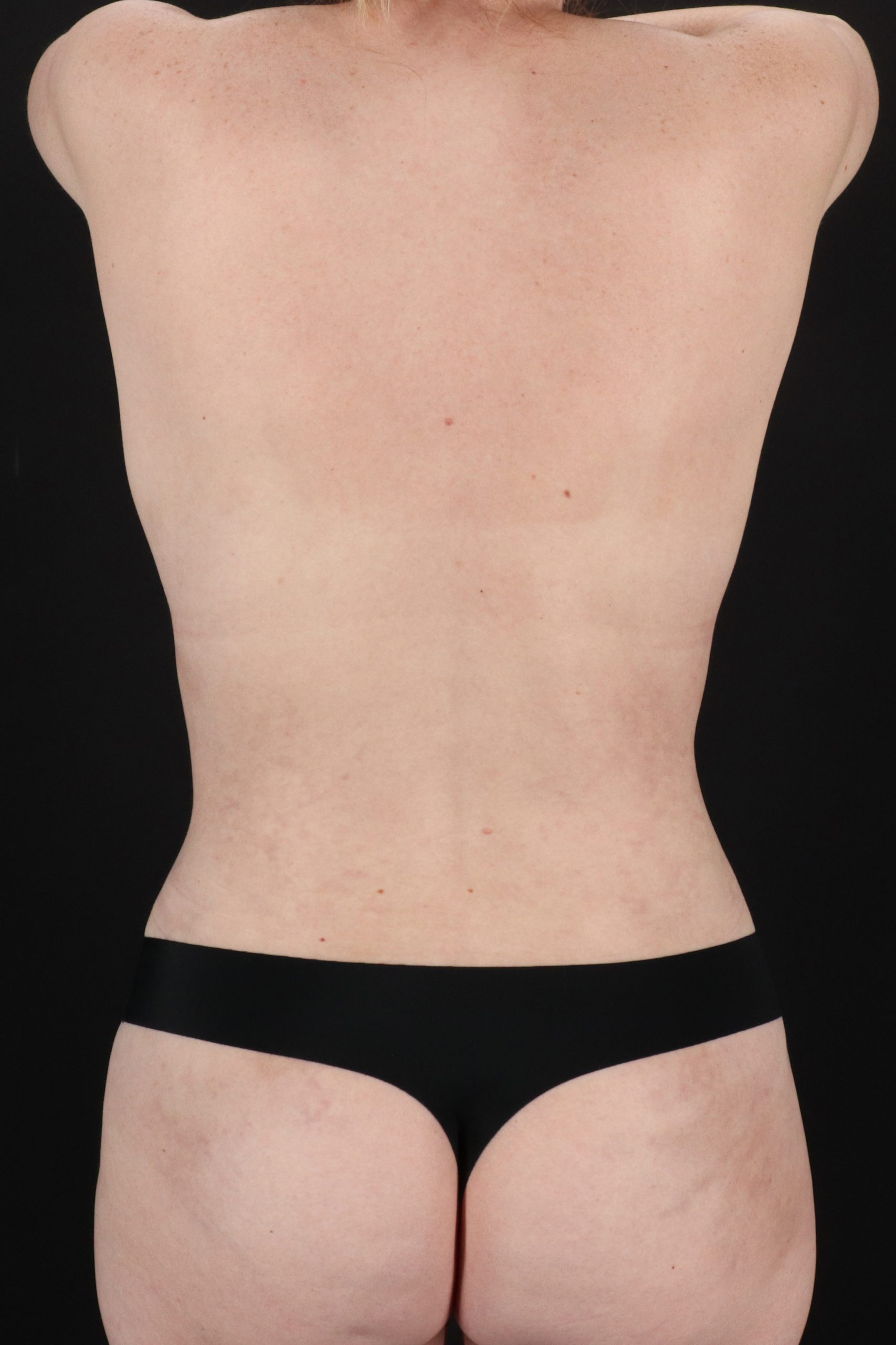 All Me Augmentation Before & After Patient #10288