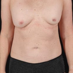 All Me Augmentation Before & After Patient #10289