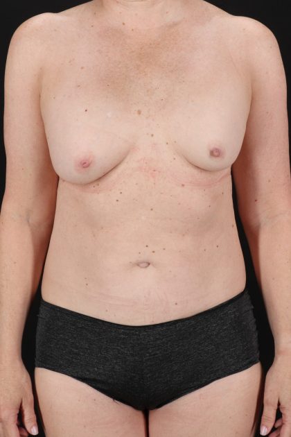 All Me Augmentation Before & After Patient #10289