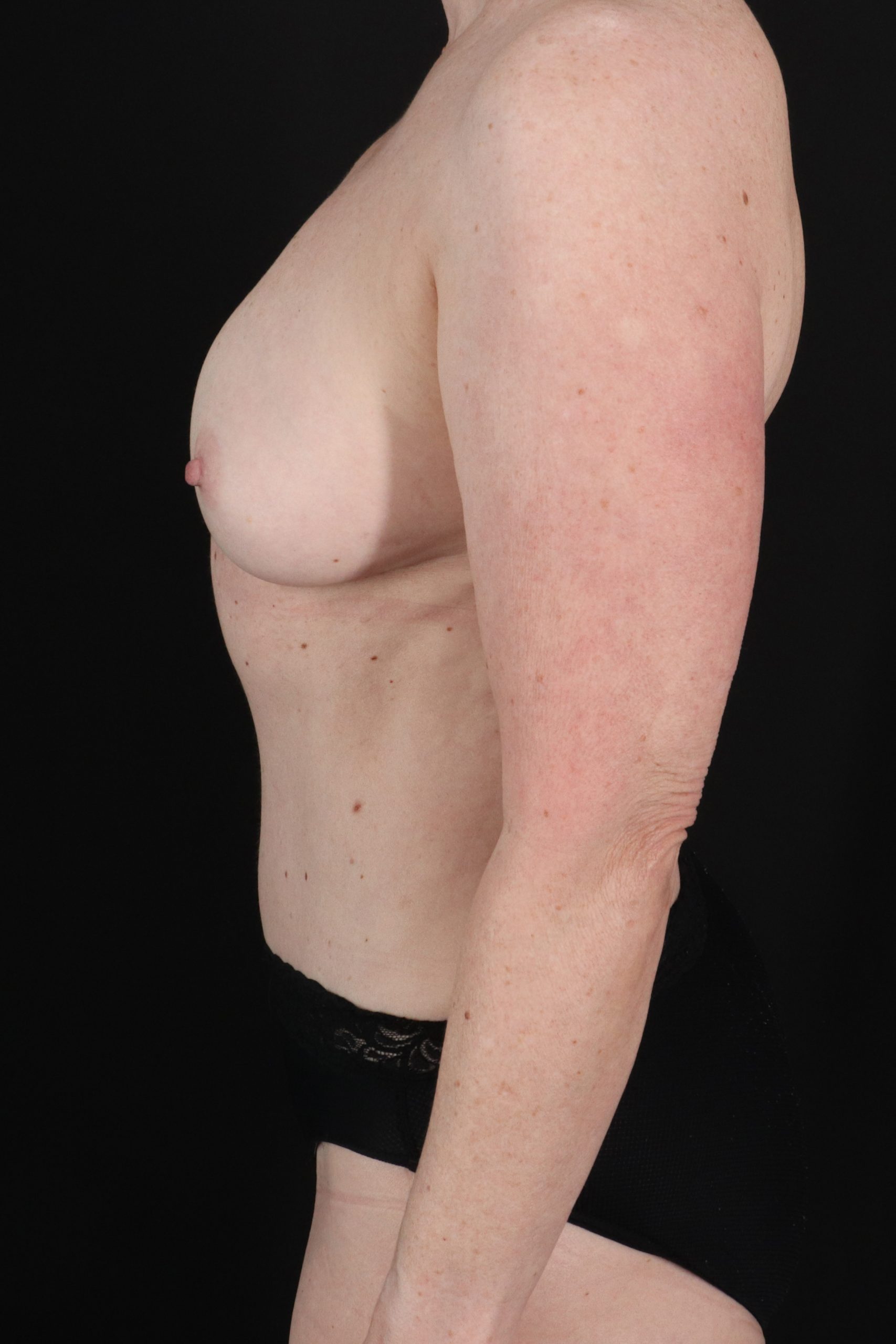 All Me Augmentation Before & After Patient #10289