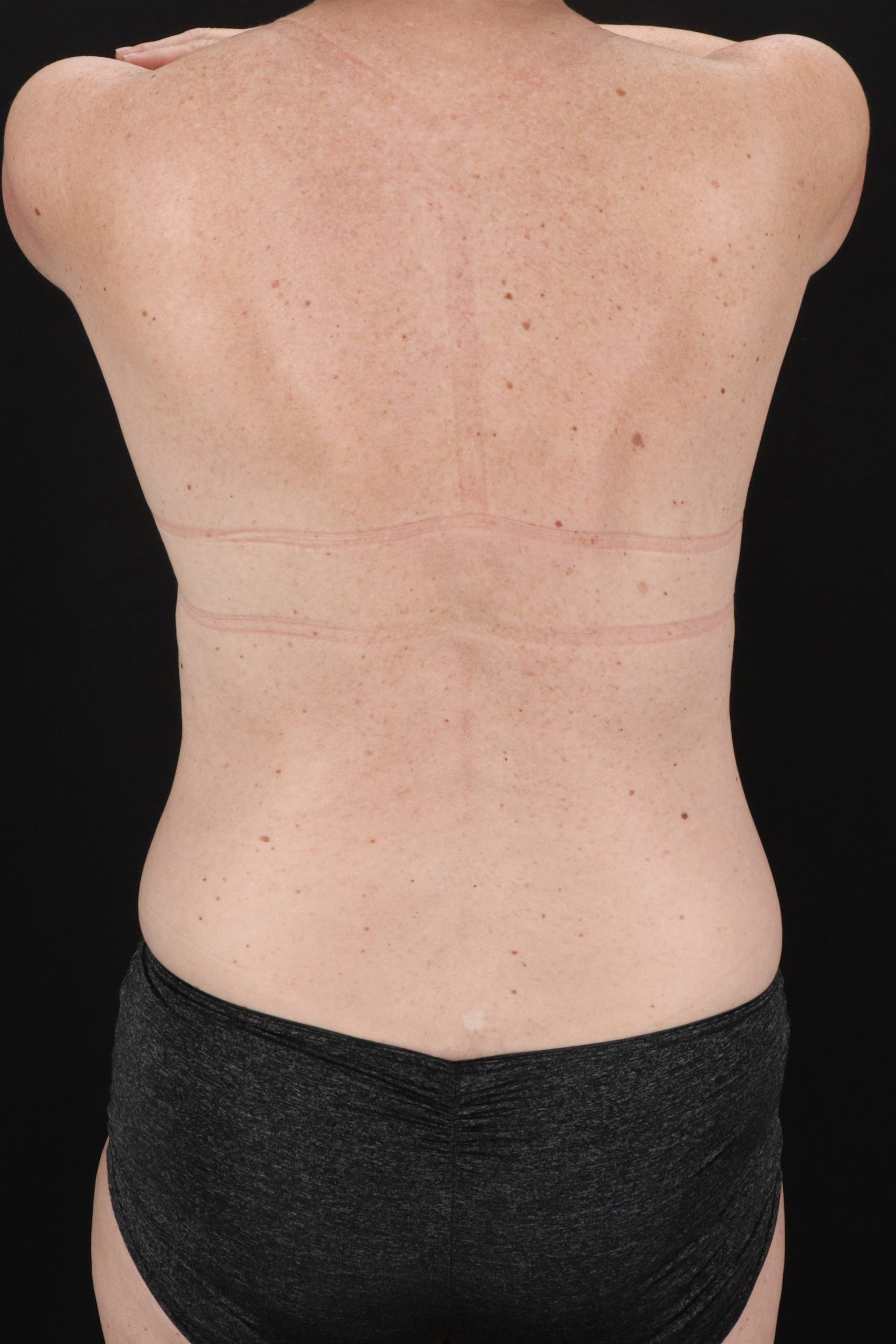 All Me Augmentation Before & After Patient #10289