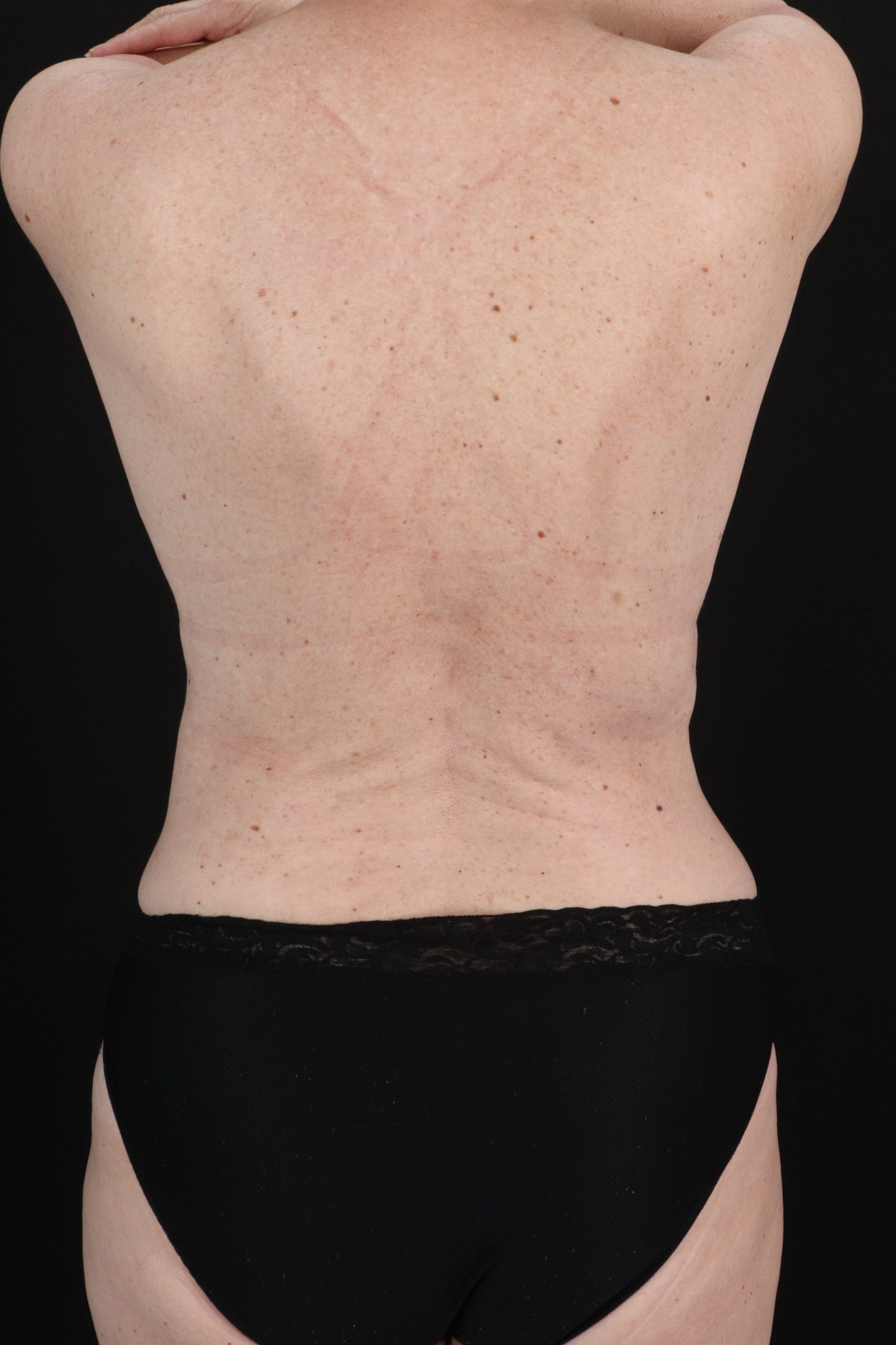 All Me Augmentation Before & After Patient #10289