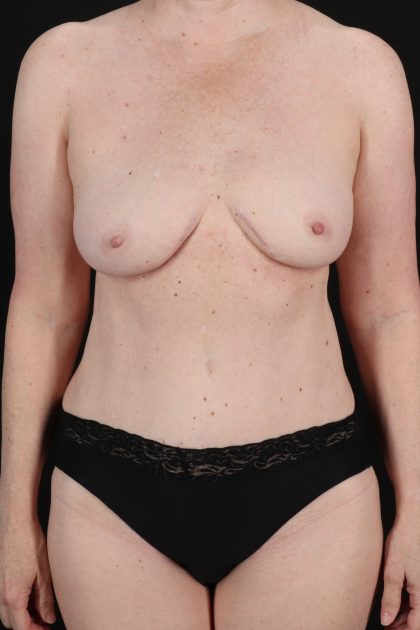 All Me Augmentation Before & After Patient #10289
