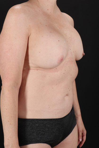 All Me Augmentation Before & After Patient #10289