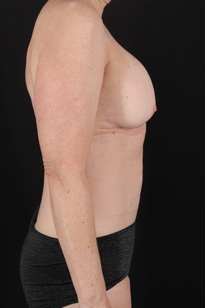 All Me Augmentation Before & After Patient #10289