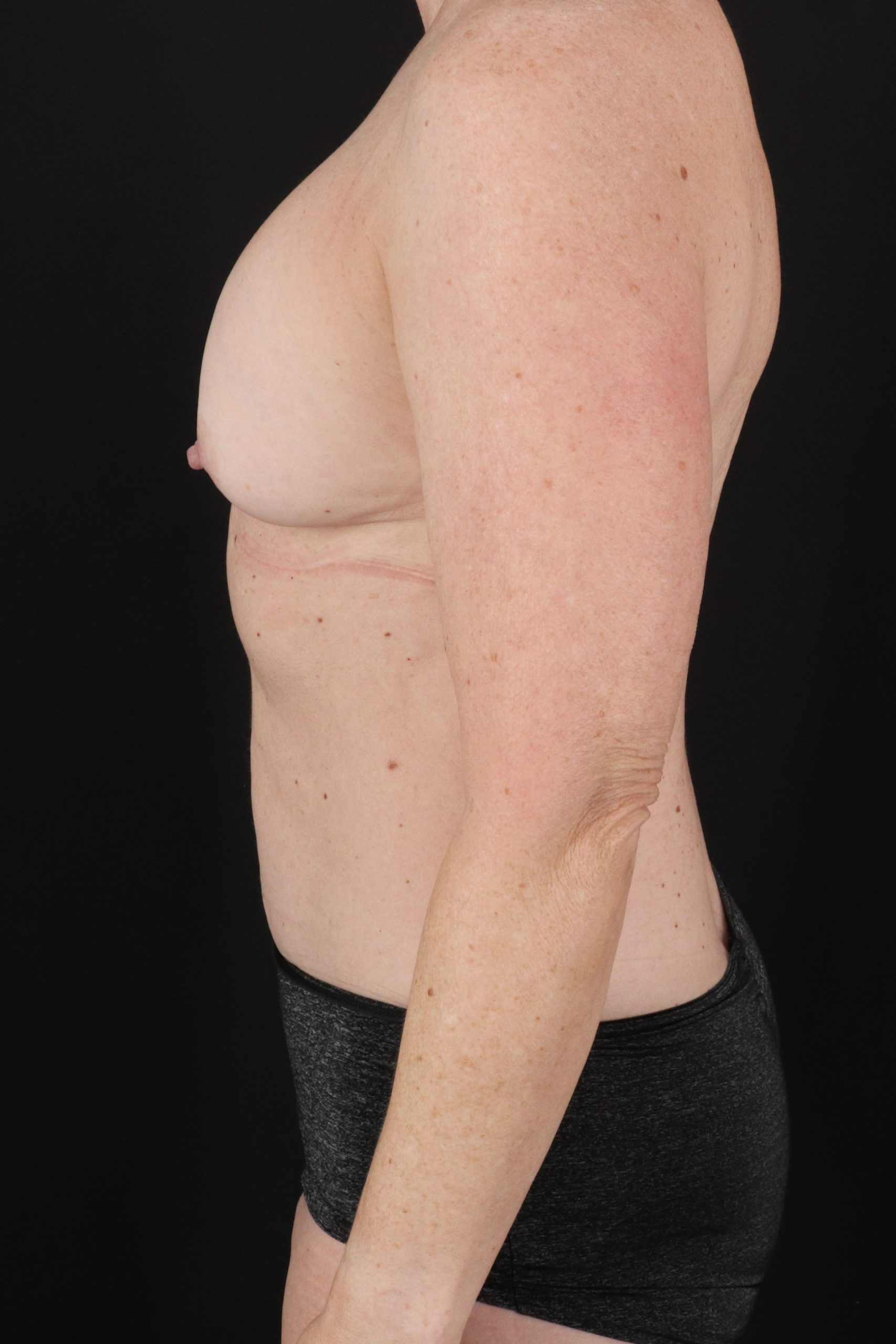 All Me Augmentation Before & After Patient #10289