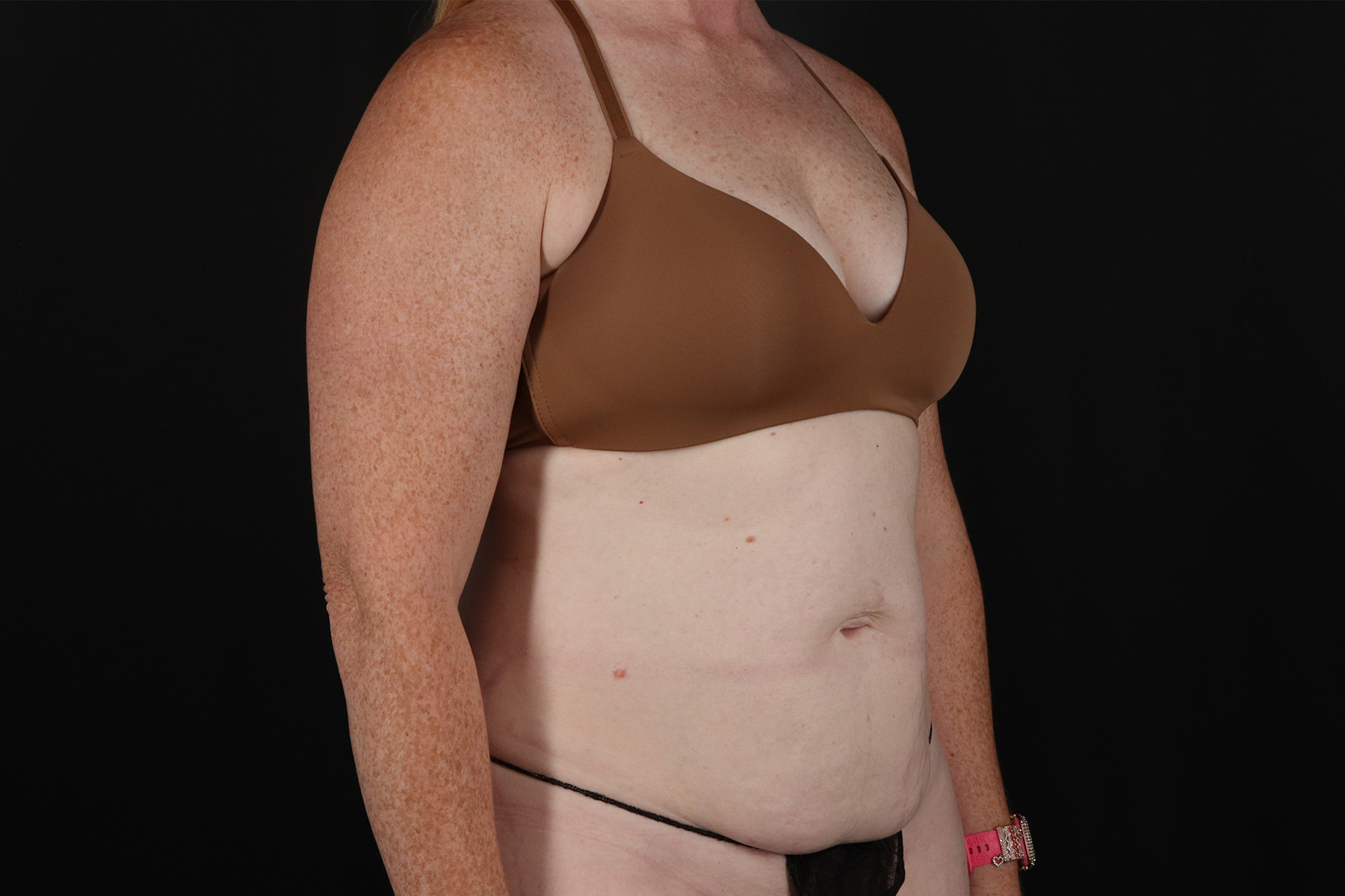 Abdominoplasty (Tummy Tuck) Before & After Patient #9980
