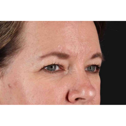 Brow Lift Before & After Patient #10859