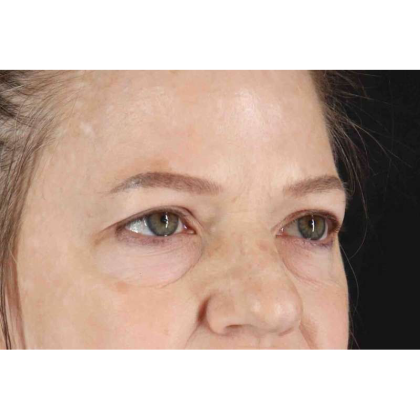 Brow Lift Before & After Patient #10848