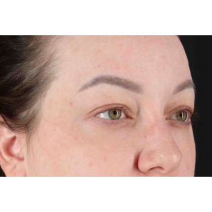 Brow Lift Before & After Patient #10837