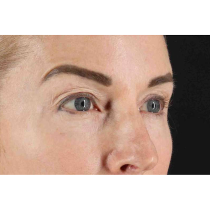 CO2 Laser Before & After Patient #10551