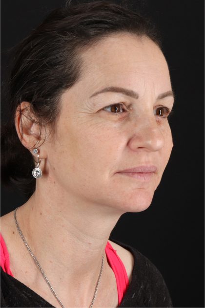 Chemical Peels Before & After Patient #11418