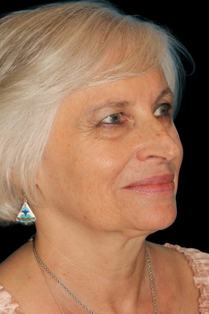 Upper Blepharoplasty Before & After Patient #11996