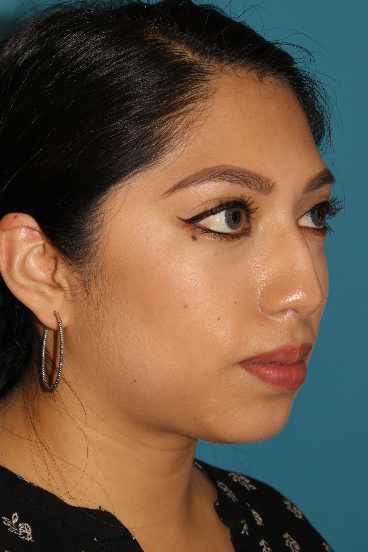 Chin Implant Before & After Patient #13673