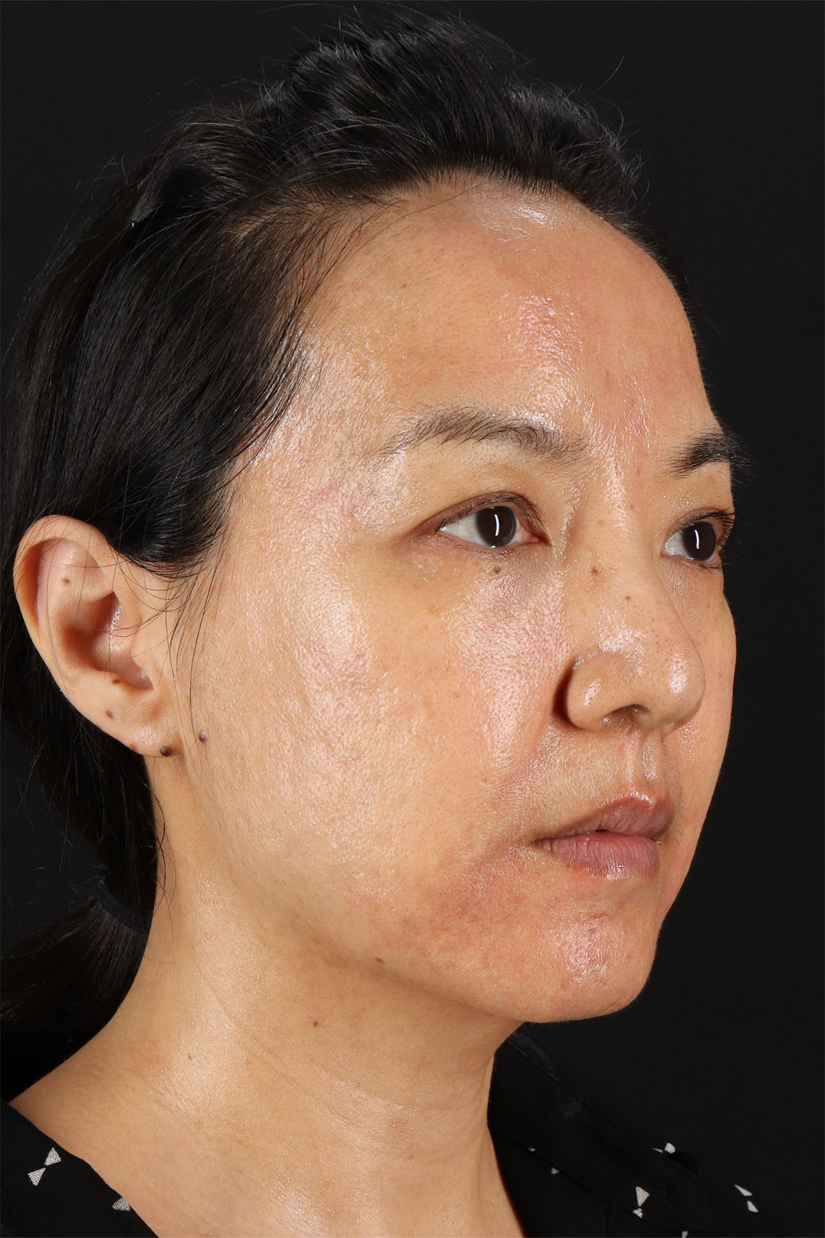 CO2 Laser Before & After Patient #11059