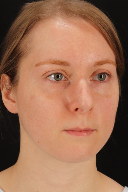 Rhinoplasty Before & After Patient #12238