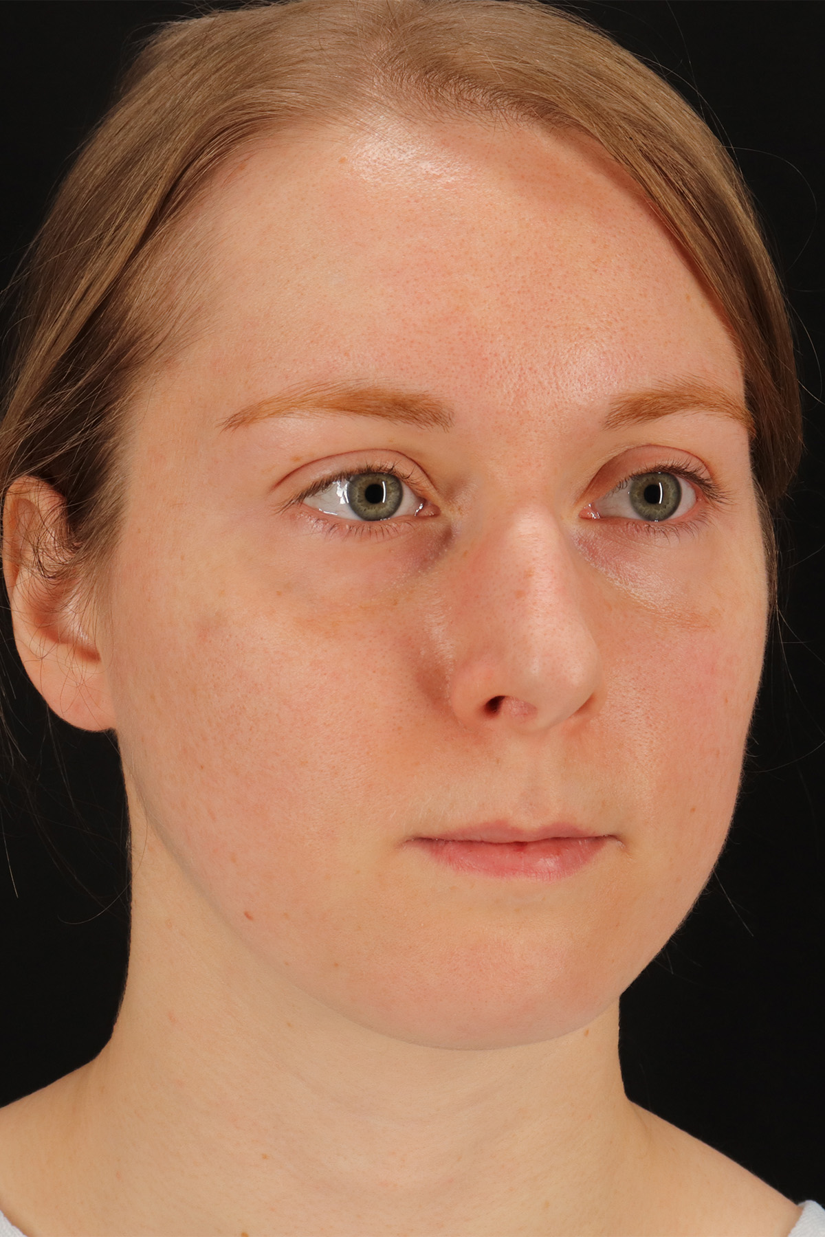 Rhinoplasty Before & After Patient #12238