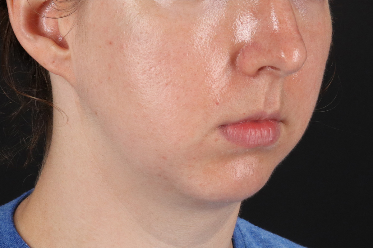 Chin Implant Before & After Patient #13761