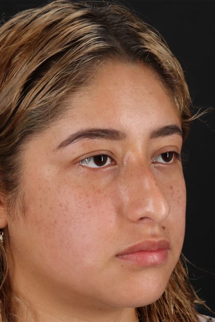 Rhinoplasty Before & After Patient #12491