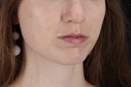 Buccal Fat Pad Before & After Patient #14025
