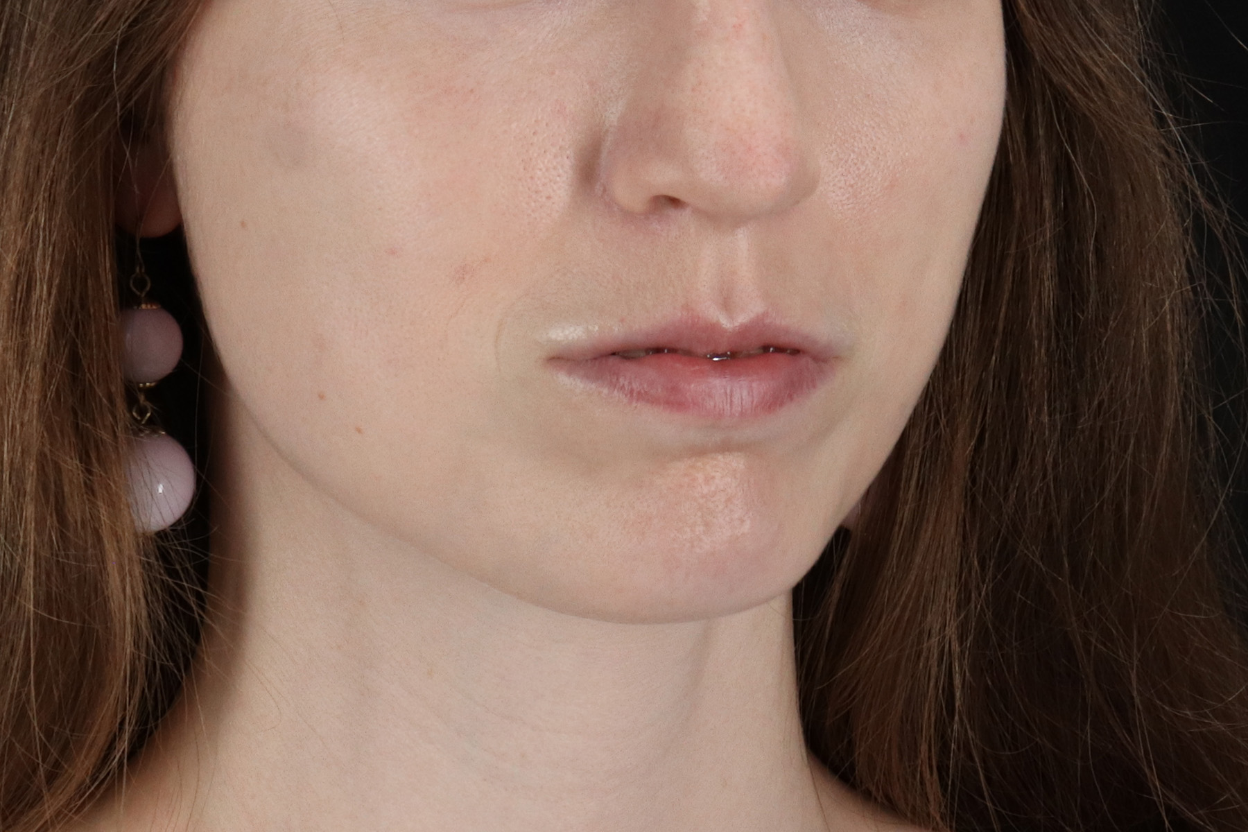 Buccal Fat Pad Before & After Patient #14025