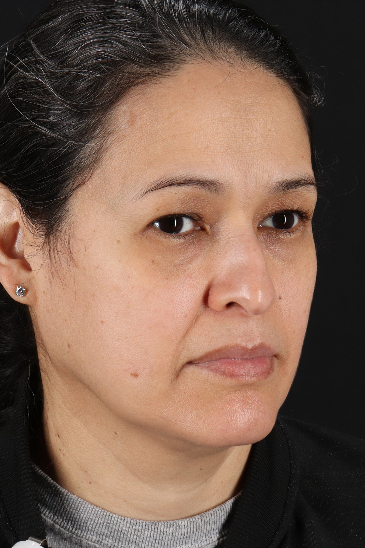 Lower Blepharoplasty Before & After Patient #13019