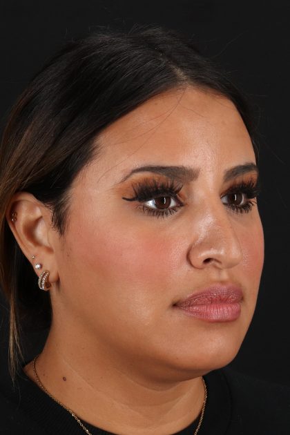 Rhinoplasty Before & After Patient #12183