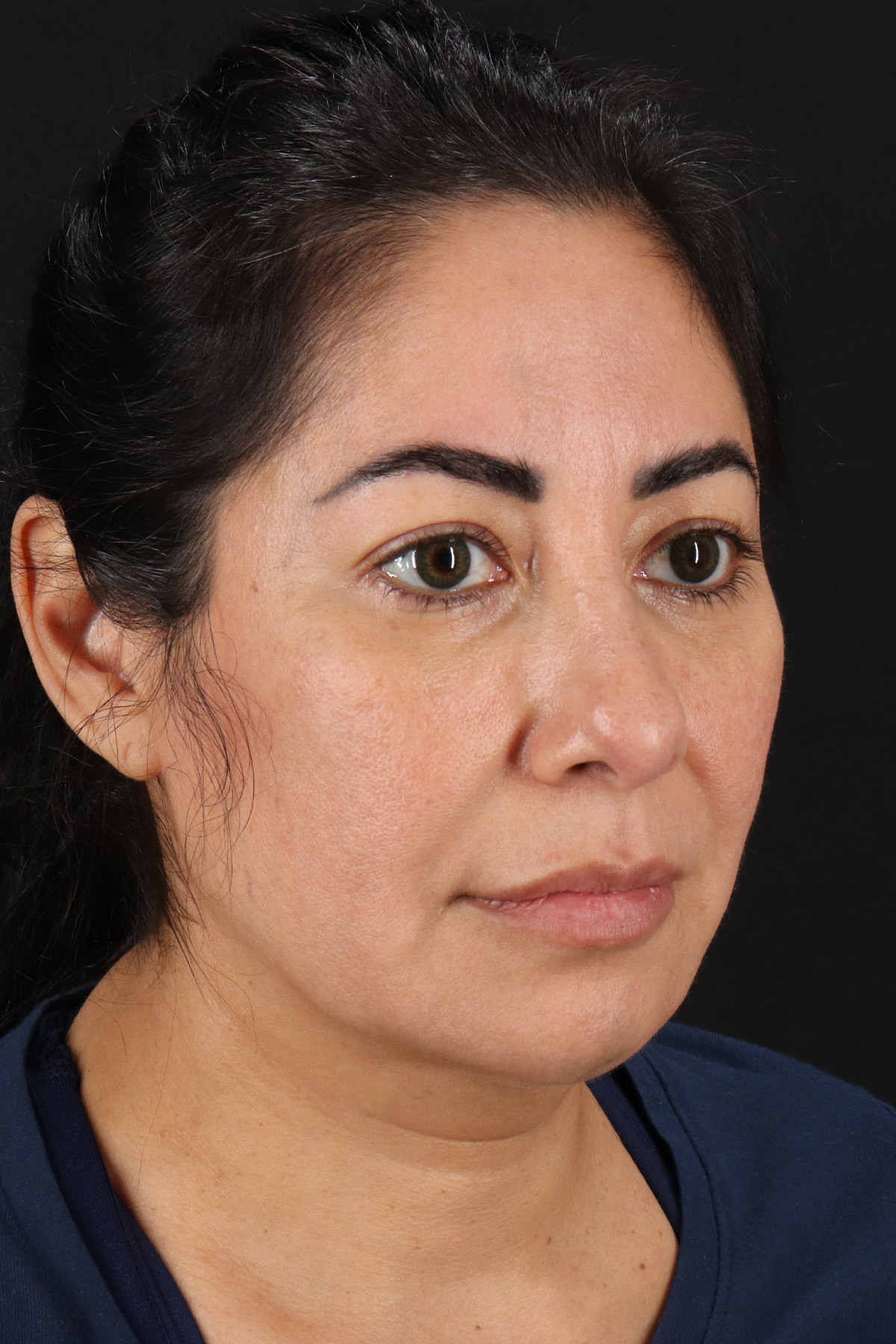 Buccal Fat Pad Before & After Patient #14014