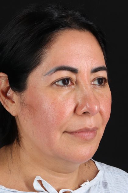 Upper Blepharoplasty Before & After Patient #12062