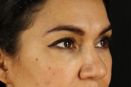Upper Blepharoplasty Before & After Patient #12007