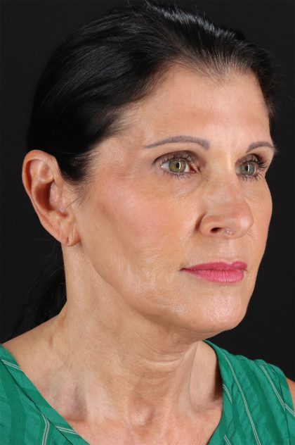 Neck Lift Before & After Patient #12887