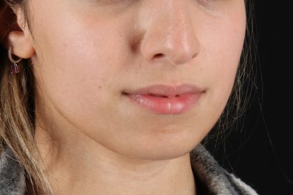 Chin Implant Before & After Patient #13750