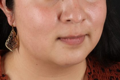Neck Liposuction Before & After Patient #12106