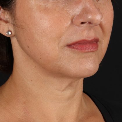 Neck Lift Before & After Patient #12953