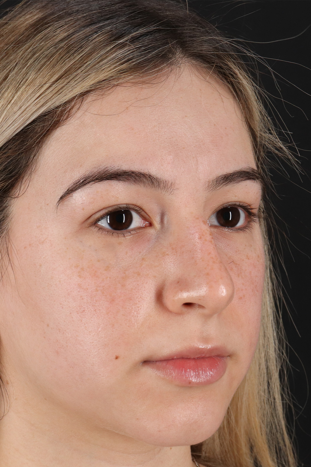 Rhinoplasty Before & After Patient #12271