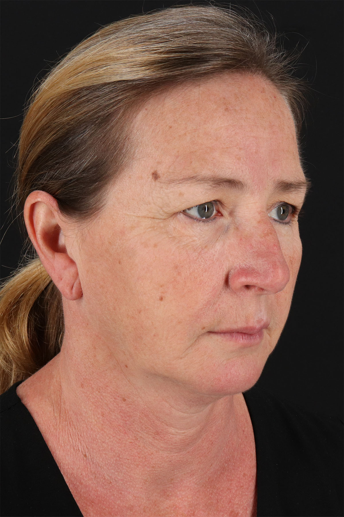 Lower Blepharoplasty Before & After Patient #13074
