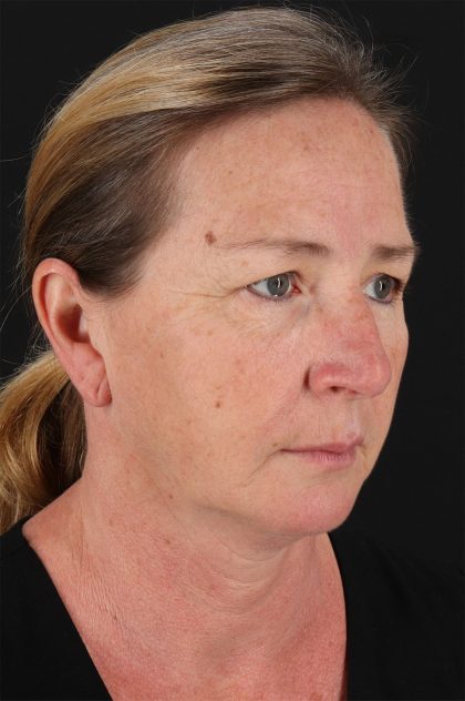 Upper Blepharoplasty Before & After Patient #12040