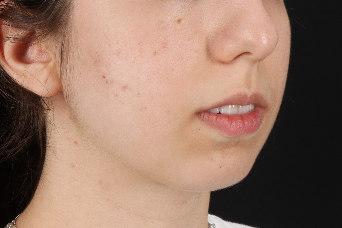 Chin Implant Before & After Patient #13772