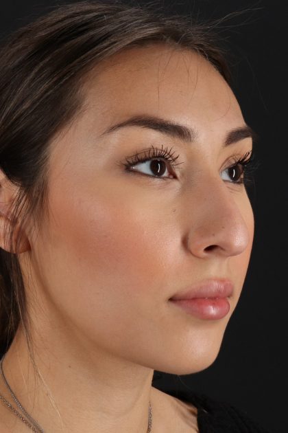 Rhinoplasty Before & After Patient #12480