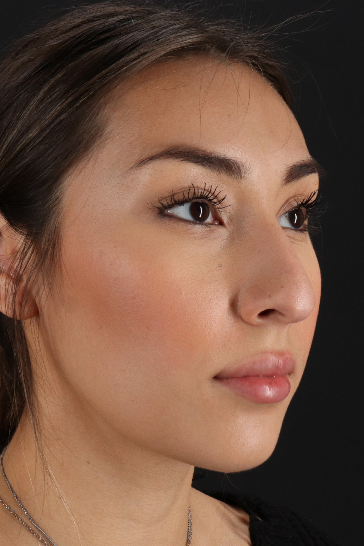 Rhinoplasty Before & After Patient #12480