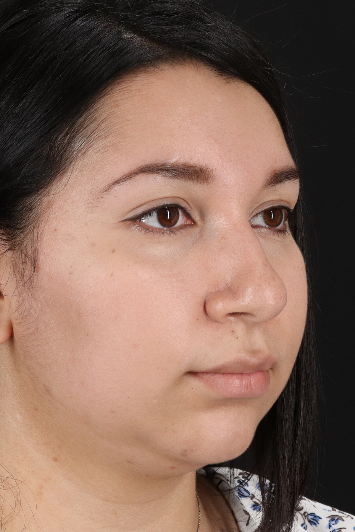 Chin Implant Before & After Patient #13739