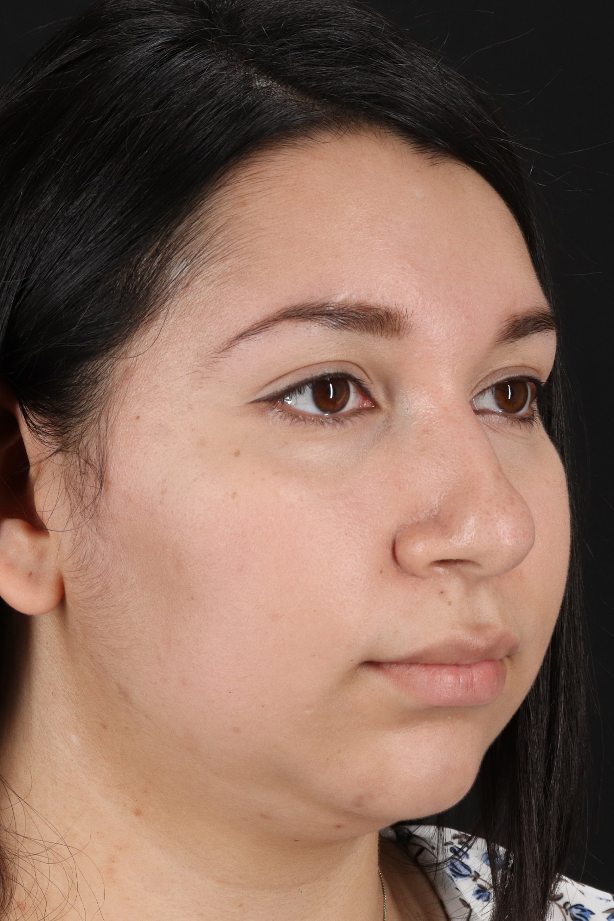 Neck Lift Before & After Patient #11698